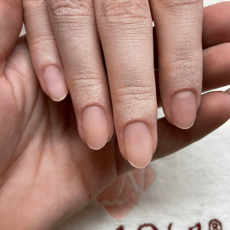 A hiperhidrózis, avagy a fokozott kézizzadás kezelése 