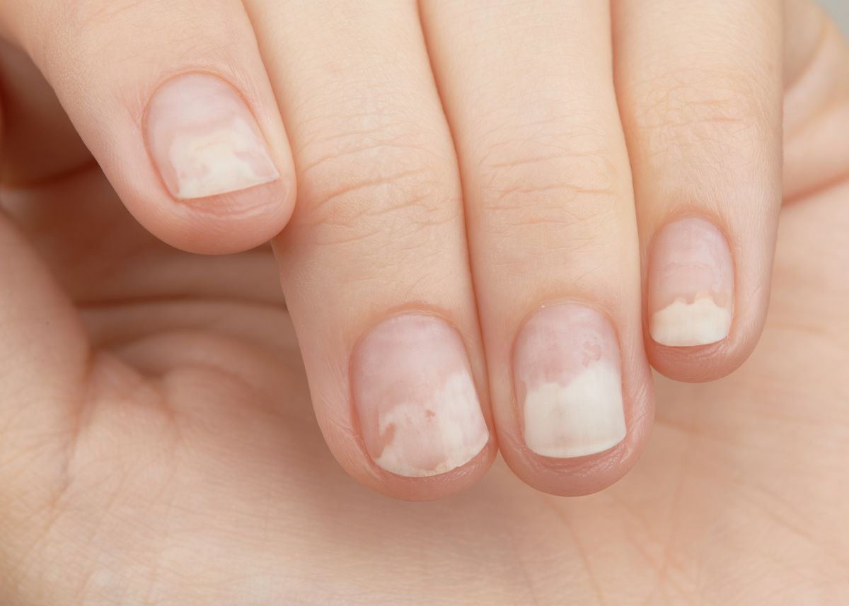 Az egyik leggyakoribb körömbetegség 