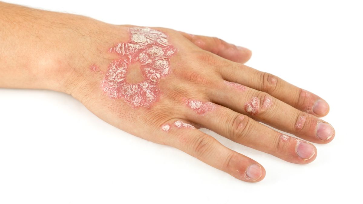 Psoriasis vulgaris (pikkelysömör)