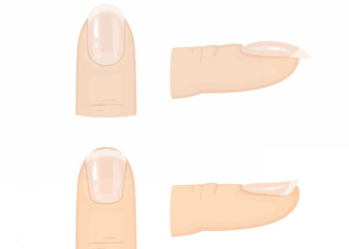 Karvaly és kanálköröm felül- és oldalnézetből